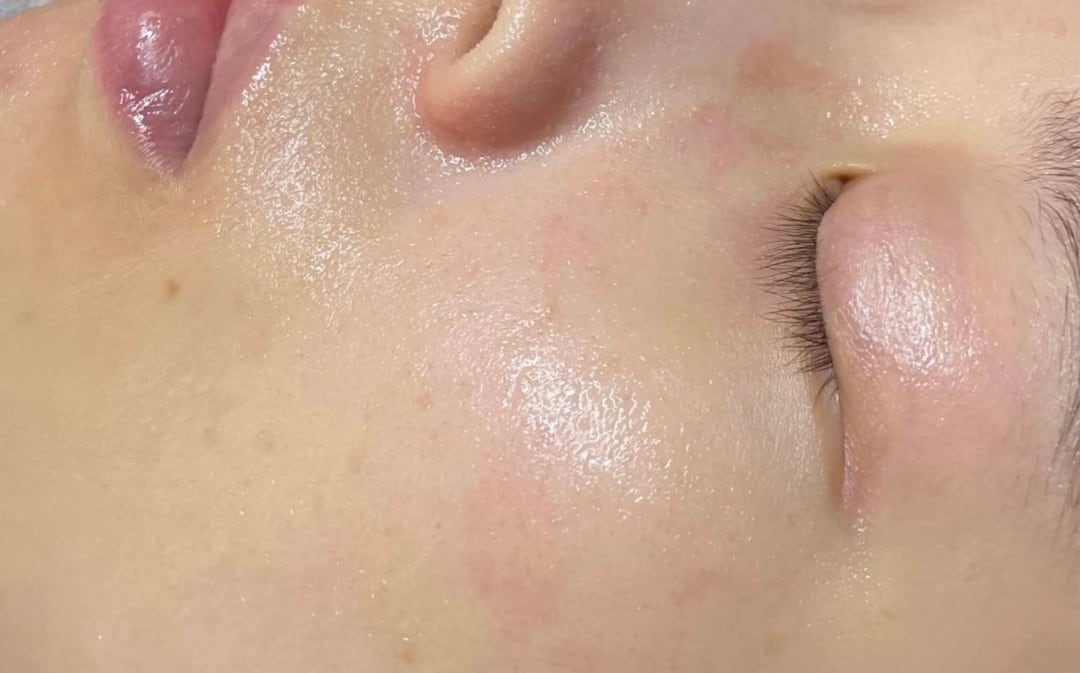 HydraFacial — After