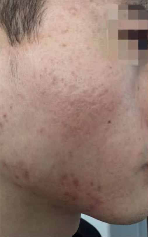 IPL Photofacial + HydraFacial — Before