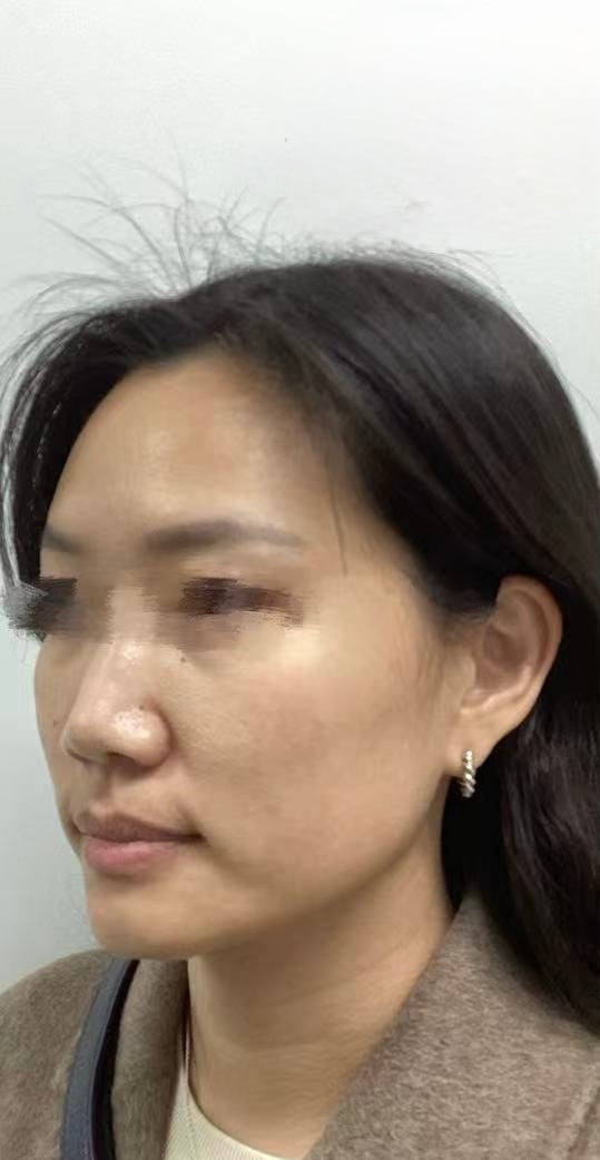 Thermage FLX — Before